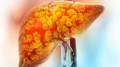 المرحلة-الرابعة-من-سرطان-الكبد.-أعراض-متقدمة-وعلاجات-لتخفيف-تطور-المرض