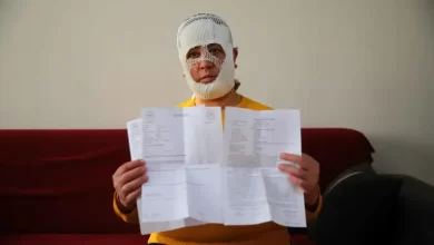 فاجعة-تجميلية.-سيدة-تركية-تفقد-ملامح-وجهها-في-مركز-تجميل-(فيديو)